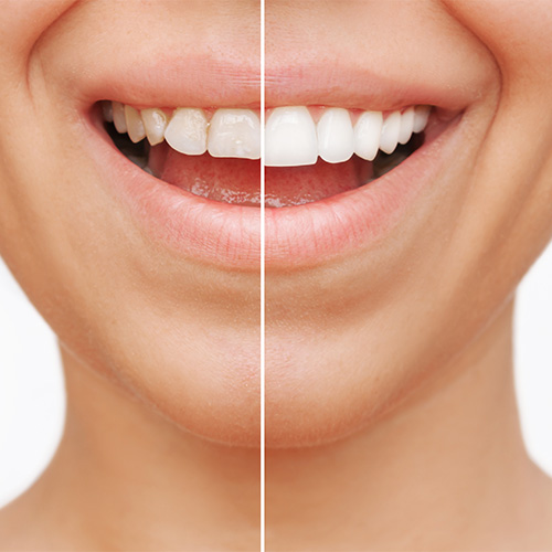 Woman's Smile Showing Difference before and after Dental Veneers